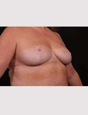 After Image: Outer Chest Skin Excision - right-front-oblique