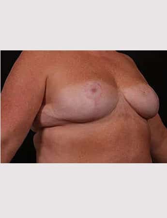 Before Image: Outer Chest Skin Excision - right-front-oblique