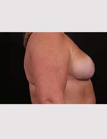 After Image: Outer Chest Skin Excision - right-side