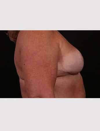 Before Image: Outer Chest Skin Excision - right-side