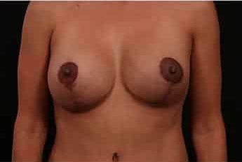 After Image: Breast Lift (Mastopexy) with Augmentation - front