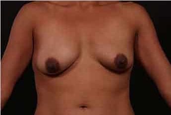 Breast Lift (Mastopexy) with Augmentation