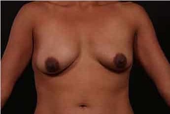 Before Image: Breast Lift (Mastopexy) with Augmentation - front