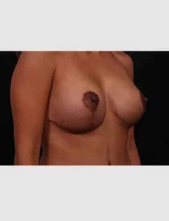 After Image: Breast Lift (Mastopexy) with Augmentation - right-front-oblique