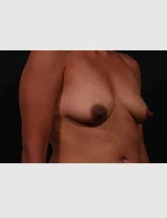 Before Image: Breast Lift (Mastopexy) with Augmentation - right-front-oblique