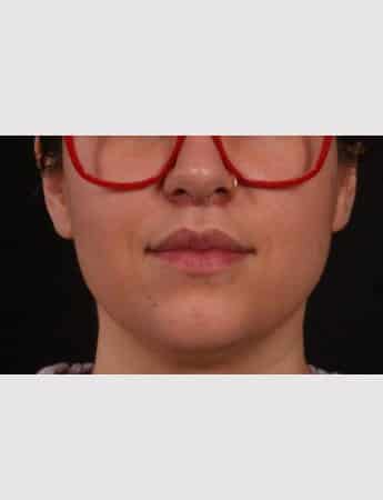 After Image: Lip Lift - front