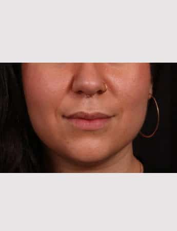 Before Image: Lip Lift - front