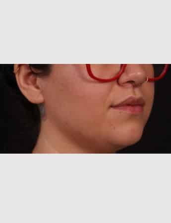 After Image: Lip Lift - right-front-oblique
