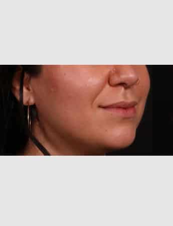 Before Image: Lip Lift - right-front-oblique