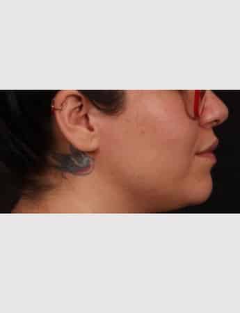 After Image: Lip Lift - right-side