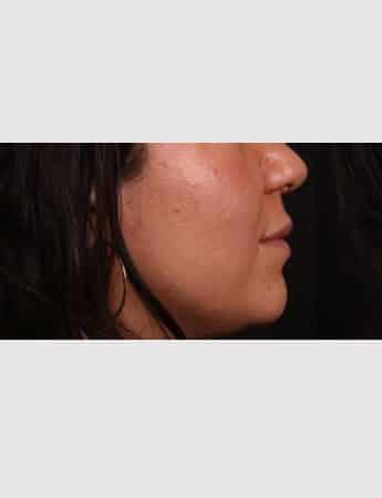 Before Image: Lip Lift - right-side