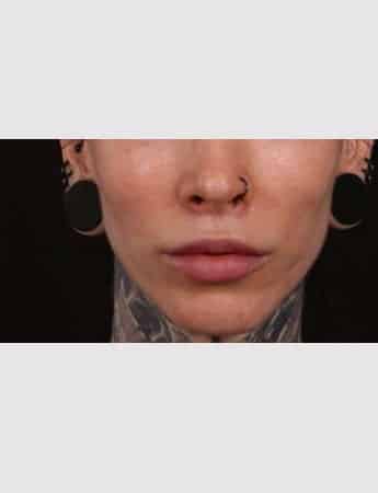 After Image: Lip Lift - front