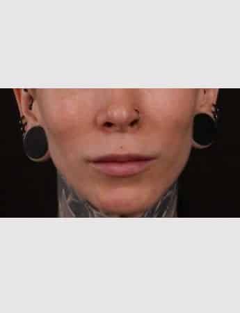 Before Image: Lip Lift - front