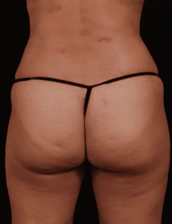 After Image: Liposuction - back
