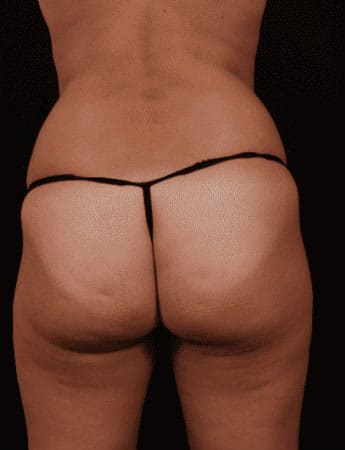 Before Image: Liposuction - back