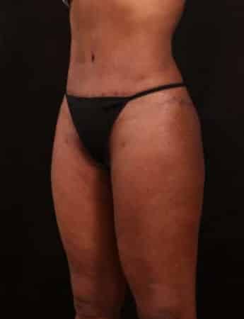After Image: Outer Thigh Lift - left-front-oblique