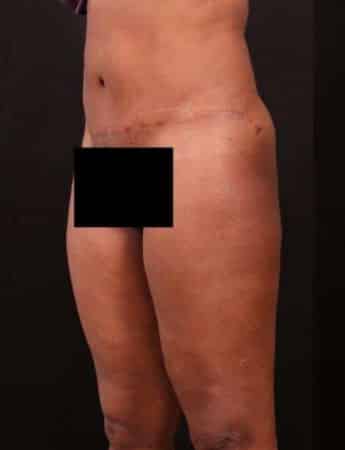 Before Image: Outer Thigh Lift - left-front-oblique