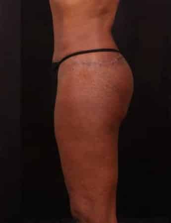After Image: Outer Thigh Lift - left-side