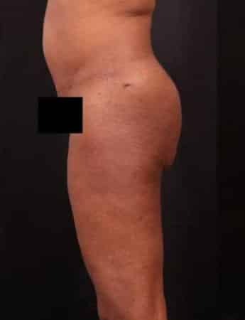 Before Image: Outer Thigh Lift - left-side