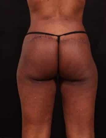 After Image: Outer Thigh Lift - back