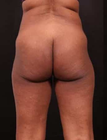 Before Image: Outer Thigh Lift - back