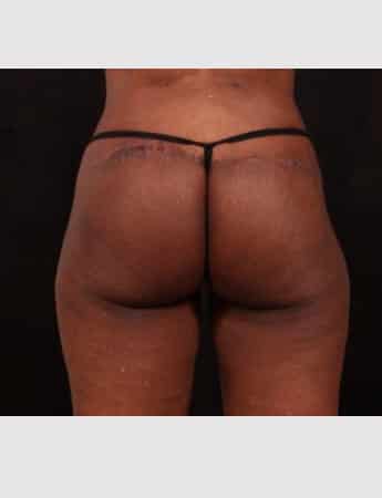 After Image: Brazilian Butt Augmentation (Butt Lift) - back