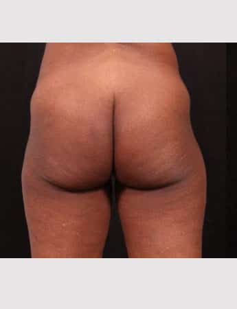 Before Image: Brazilian Butt Augmentation (Butt Lift) - back