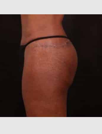 After Image: Brazilian Butt Augmentation (Butt Lift) - left-side