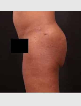 Before Image: Brazilian Butt Augmentation (Butt Lift) - left-side