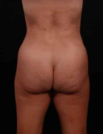 After Image: Liposuction - back