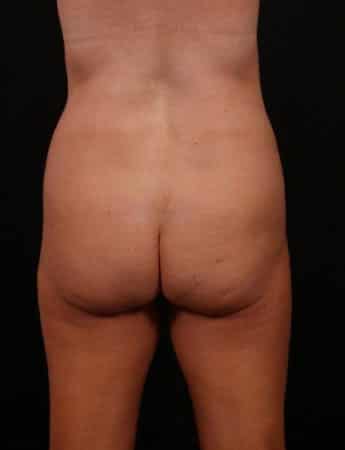Before Image: Liposuction - back