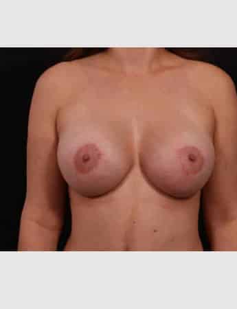 After Image: Breast Augmentation with Peri Areolar Lift - front