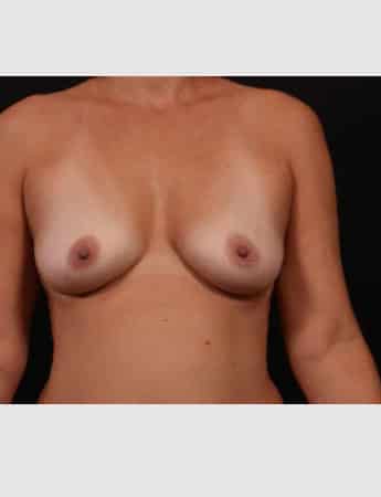 Before Image: Breast Augmentation with Peri Areolar Lift - front