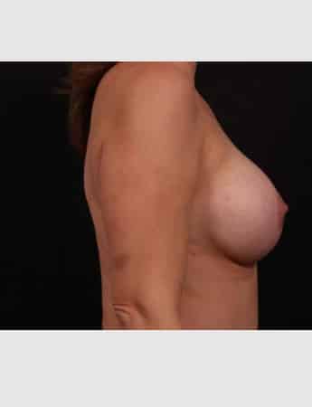 After Image: Breast Augmentation with Peri Areolar Lift - right-side