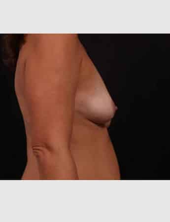 Before Image: Breast Augmentation with Peri Areolar Lift - right-side