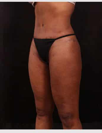 After Image: Liposuction - left-front-oblique