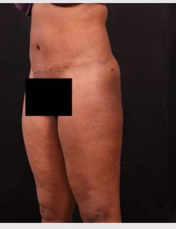 Before Image: Liposuction - left-front-oblique