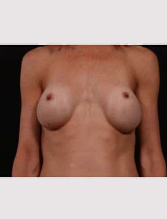 Before Image: Secondary Breast Surgery - front