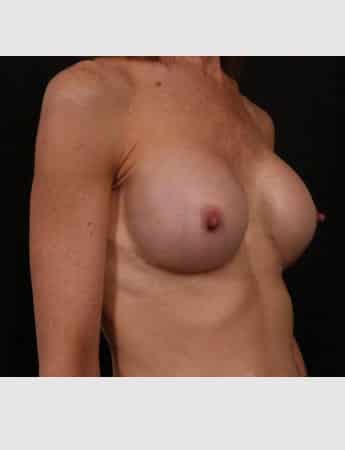 After Image: Secondary Breast Surgery - right-front-oblique