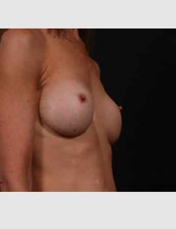 Before Image: Secondary Breast Surgery - right-front-oblique