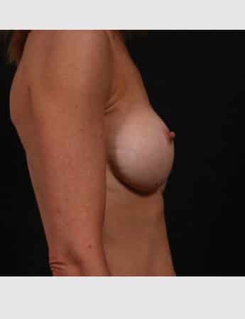Before Image: Secondary Breast Surgery - right-side