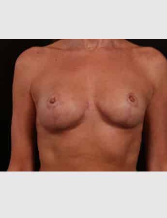 After Image: Mastopexy (Breast Lift) with Auto Augmentation - front