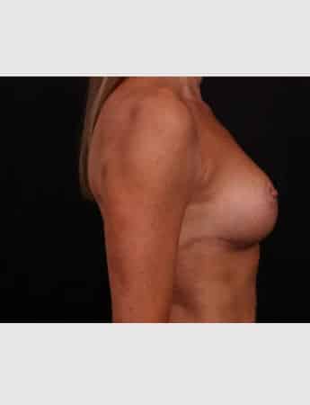 After Image: Mastopexy (Breast Lift) with Auto Augmentation - right-side