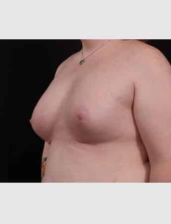 After Image: Transgender Woman Breast Augmentation - left-front-oblique