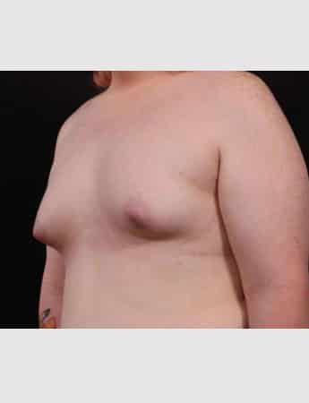 Before Image: Transgender Woman Breast Augmentation - left-front-oblique