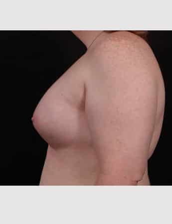 After Image: Transgender Woman Breast Augmentation -