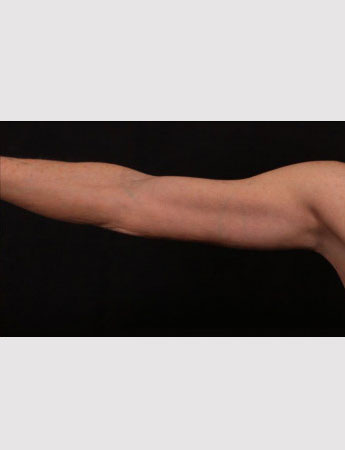 After Image: Brachioplasty (Arm Lift) - front