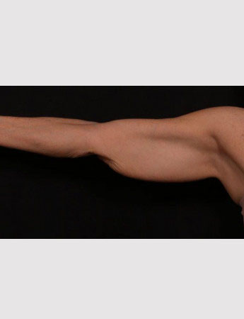 Before Image: Brachioplasty (Arm Lift) - front