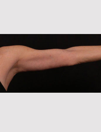After Image: Brachioplasty (Arm Lift) - front
