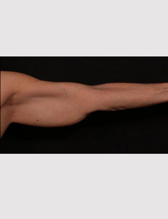 Before Image: Brachioplasty (Arm Lift) - front